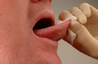 Oral Cancer Screening